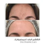 ⁦ديرما ميلان - مجموعة التقشير البارد⁩ - الصورة ⁦3⁩