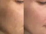 ⁦ديرما ميلان - مجموعة التقشير البارد⁩ - الصورة ⁦2⁩